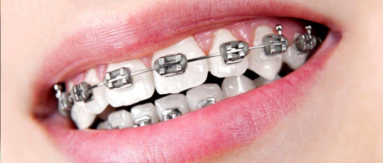 Transparent Teeth Braces and Everything about it