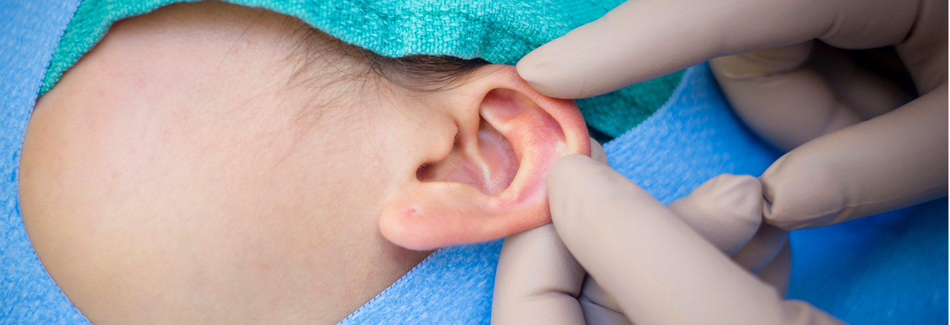 prominent ears surgery