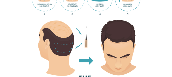 fue technique hair transplant 2