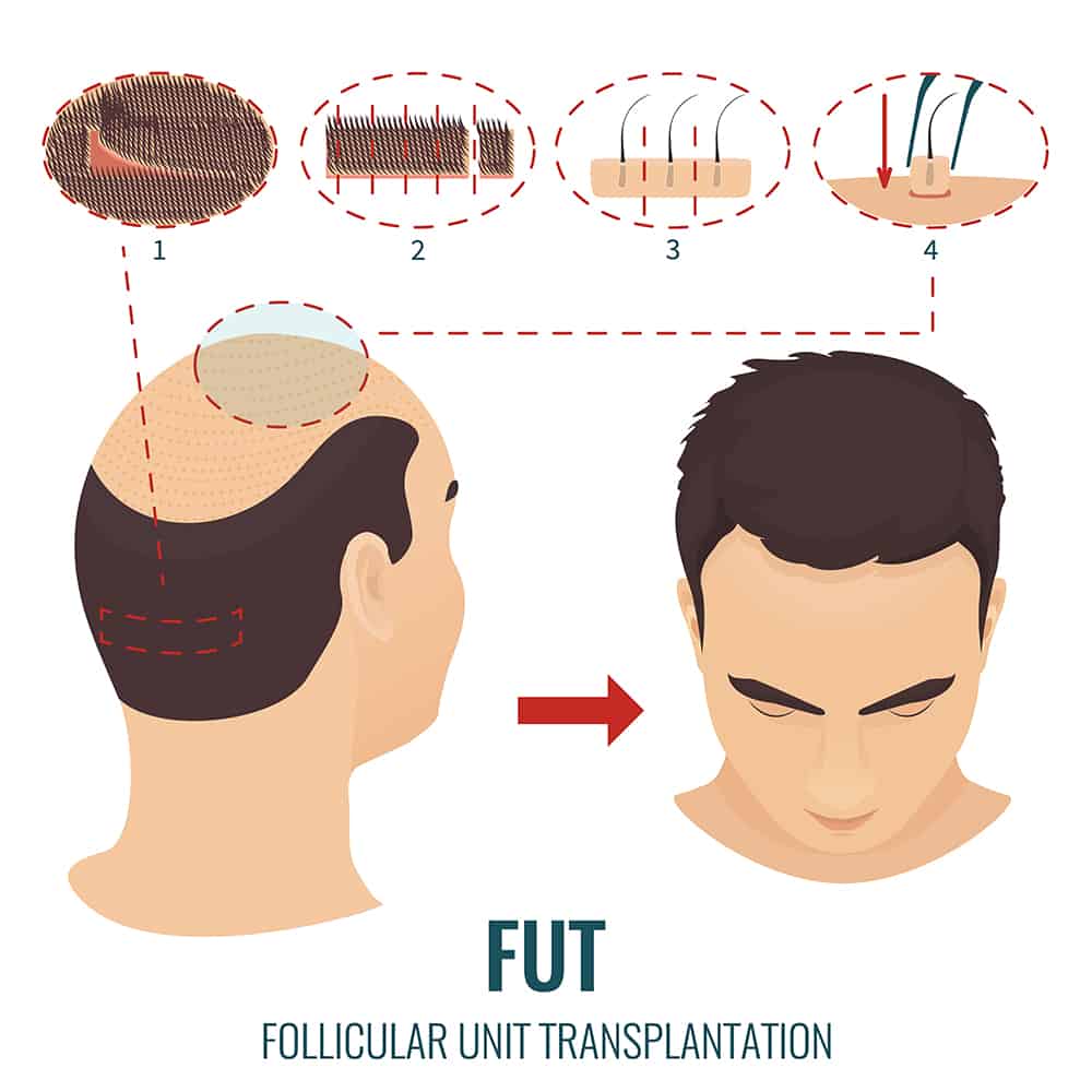 fut Follicular unit transplantation