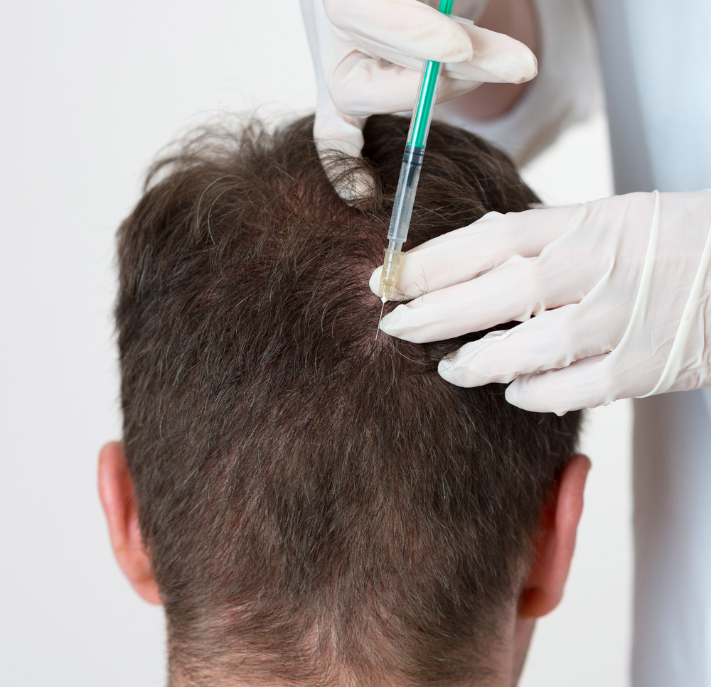 mesotherapy for hair