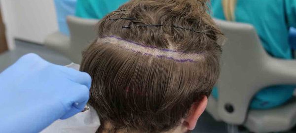 hair transplant without shaving