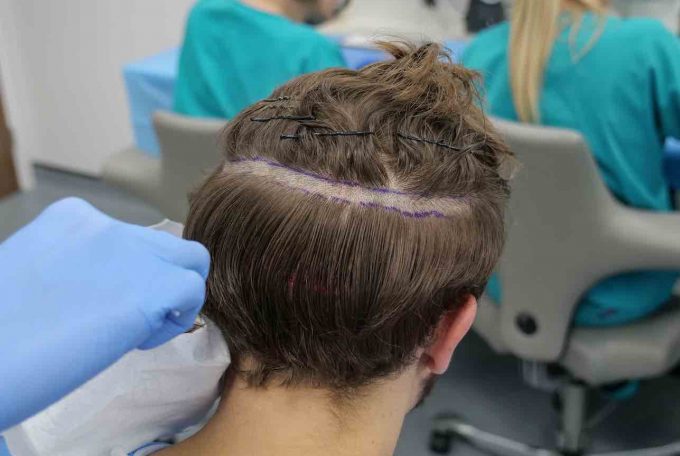 Everything about hair transplant without shaving