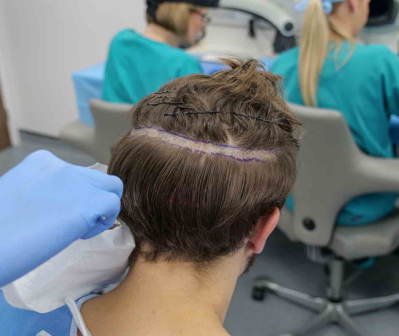Everything about hair transplant without shaving | Healing Clinic Turkey
