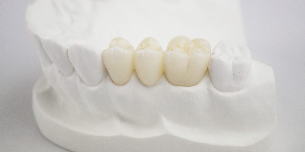 Couronnes dentaires temporaires, 120 pièces, couronnes, molaires  postérieures, capuchon en polycarbonate, couronne de placage, dent de  dentiste