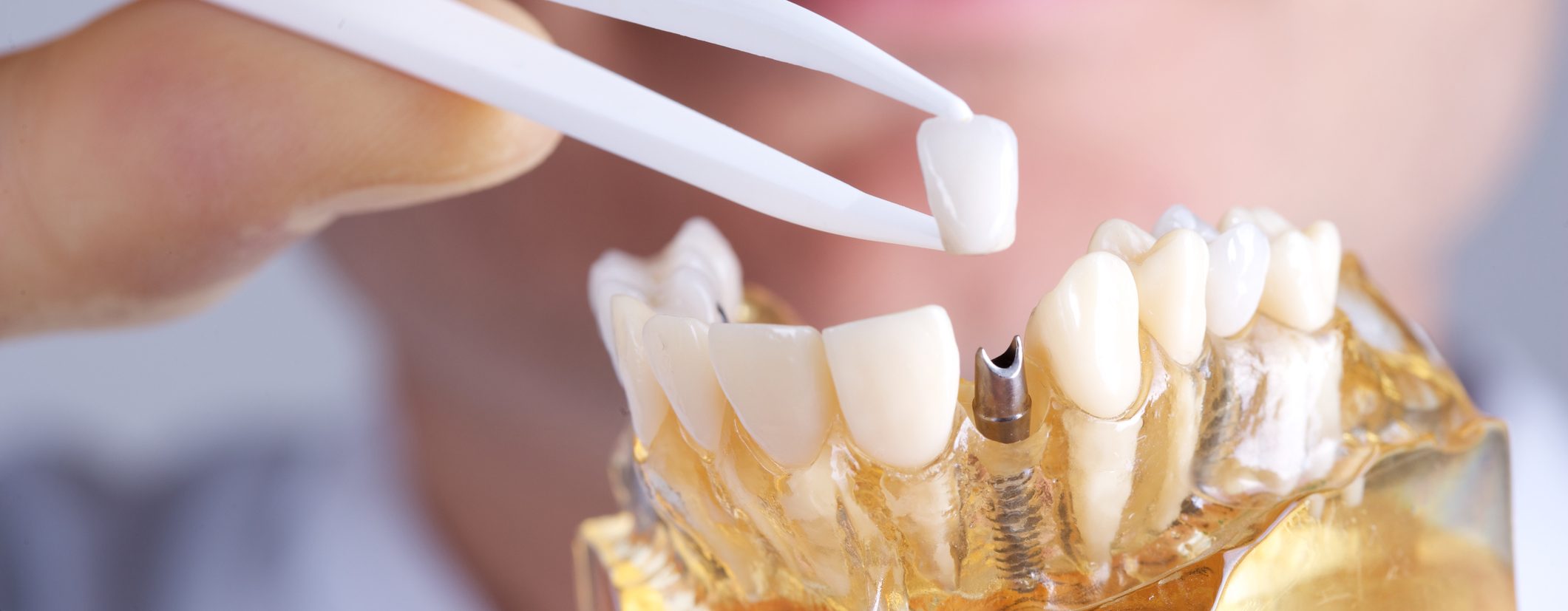 placas dentales