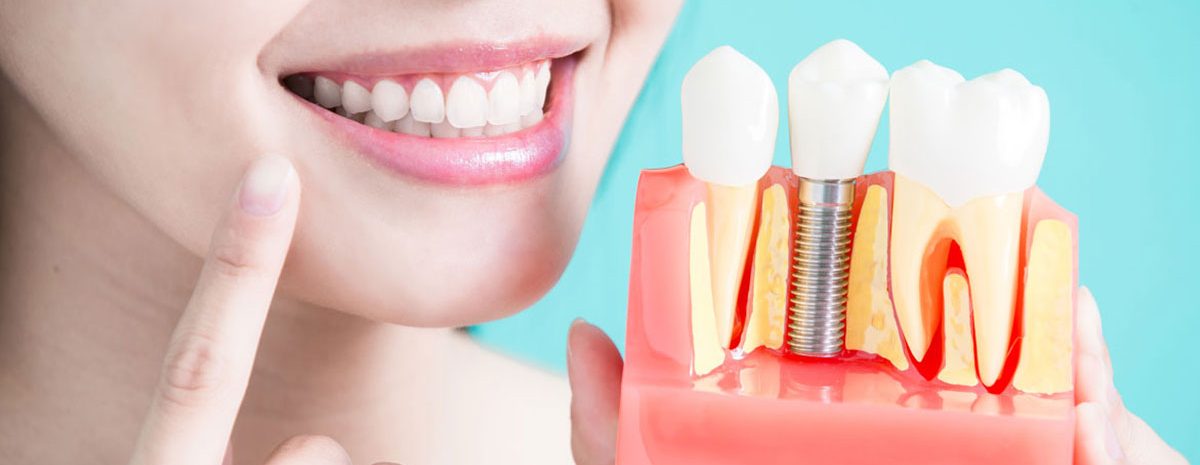 تركيبات الاسنان
