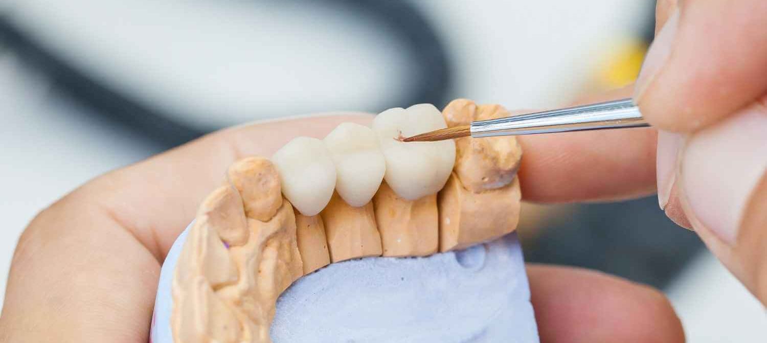 partial dental bridge