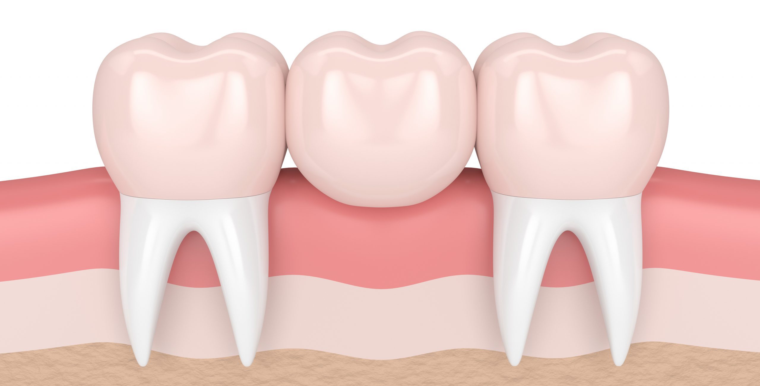 partial dental bridge