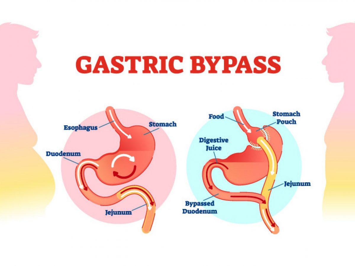 Gastric Banding Surgery: Pros and Cons ♥ Amitis
