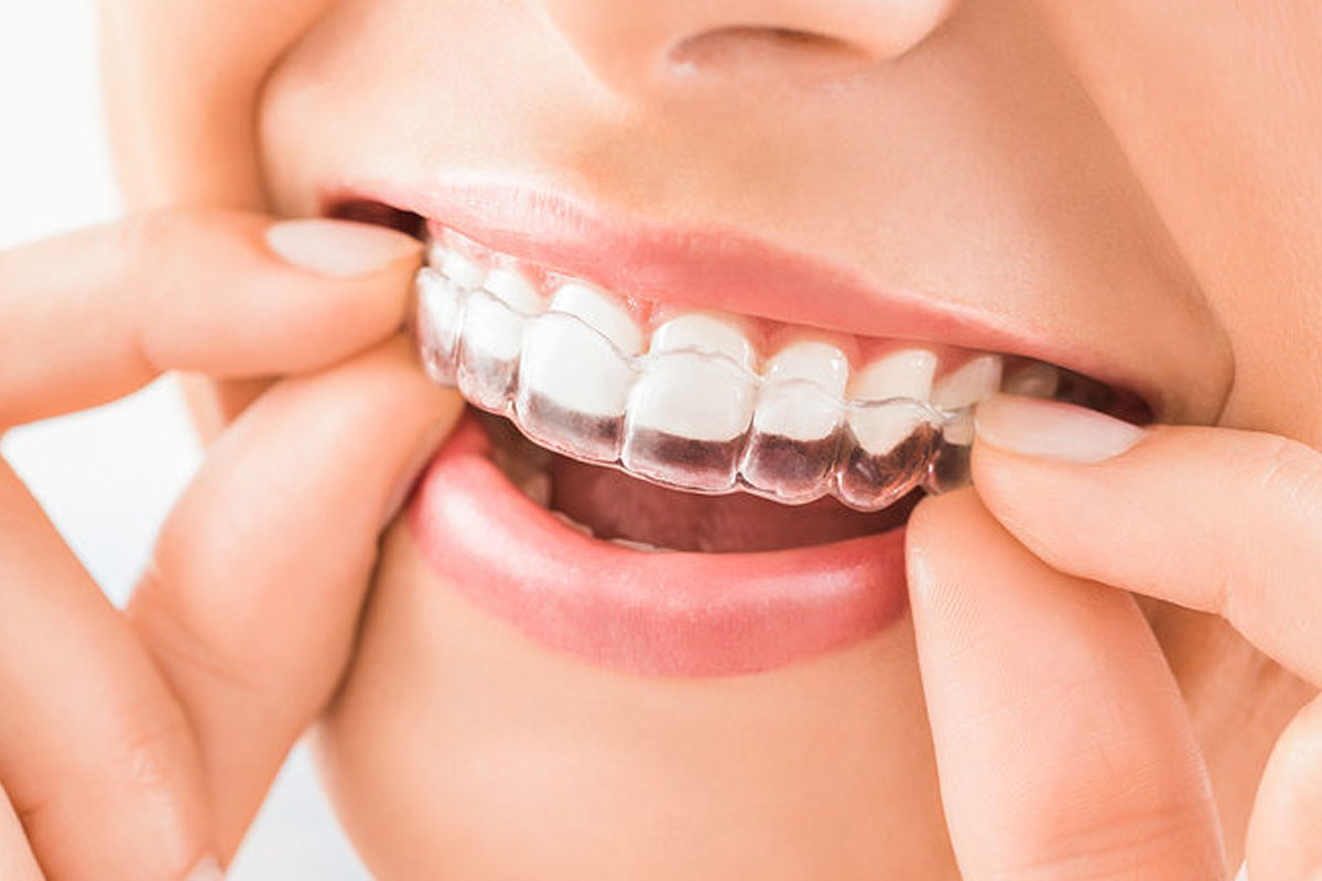 transparent teeth braces