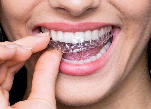 transparent teeth braces