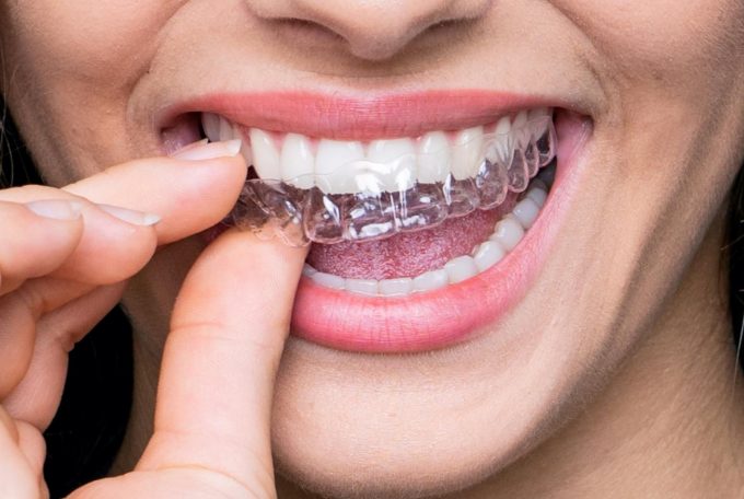 تقويم اسنان شفاف ميزة فريدة عالم الاسنان