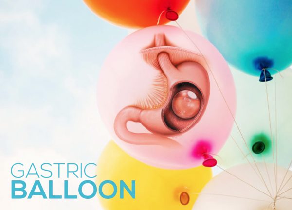 balloon gastric procedure