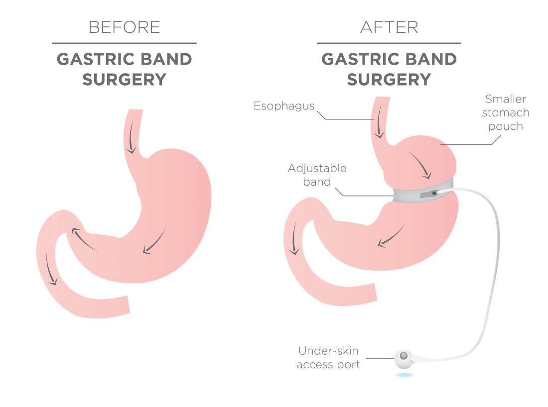 gastric banding procedure