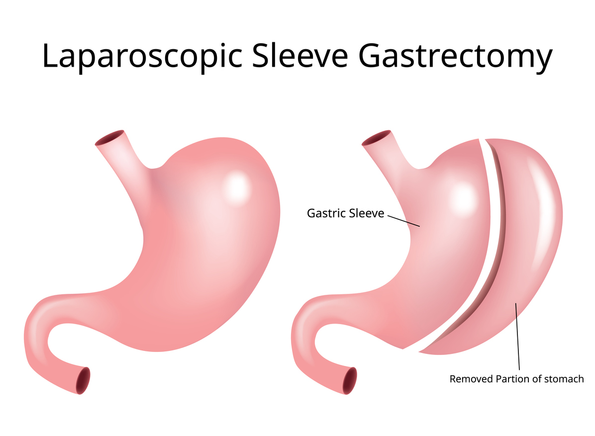 sleeve gastrectomy procedure