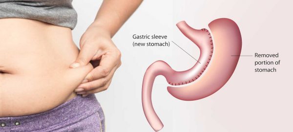 sleeve gastrectomy procedure 4