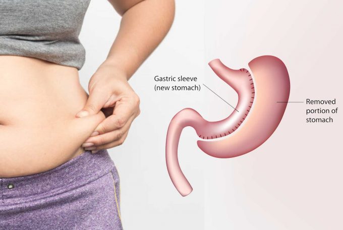 Sleeve Gastrectomy Procedure and All about it