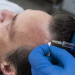 Greffe de cheveux chez les patients d’hépatites